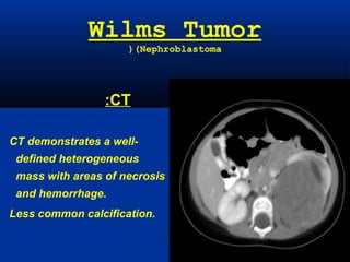 Wilms Tumor
(Nephroblastoma(
CT:
CT demonstrates a well-
defined heterogeneous
mass with areas of necrosis
and hemorrhage.
Less common calcification.
 