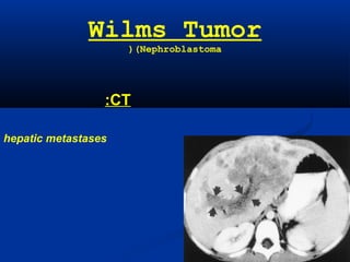Wilms Tumor
(Nephroblastoma(
CT:
hepatic metastases
CT scan shows multiple hepatic
metastases in addition to tumor
thrombus within the portal veins
(arrows).
 