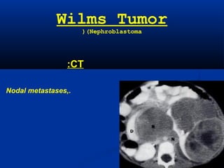 Wilms Tumor
(Nephroblastoma(
CT:
Nodal metastases,.
 