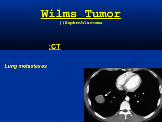 Wilms Tumor
(Nephroblastoma(
CT:
Lung metastases
 