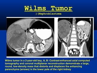 Wilms tumor in a 2-year-old boy. A, B: Contrast-enhanced axial computed
tomography and coronal multiplanar reconstruction demonstrate a large,
round, low-density mass that distorts and displaces the enhancing
parenchyma (arrows) in the lower pole of the right kidney
Wilms Tumor
(Nephroblastoma(
 