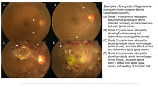 5 RETINOPATIAS hipertensión arterial y diabetes | PDF