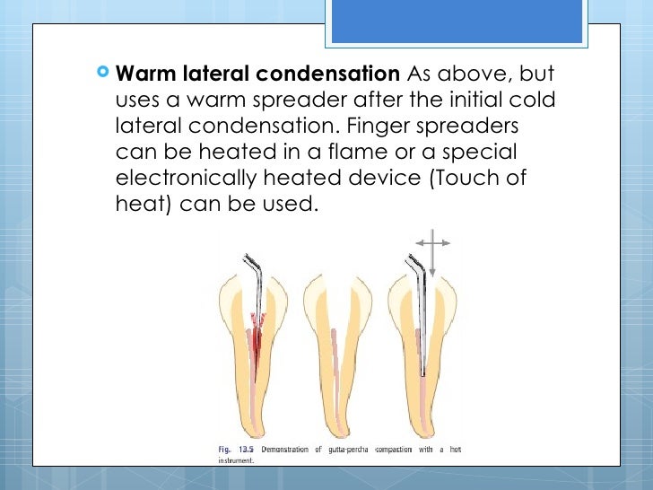 5 root canal filling materials