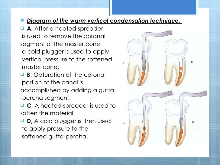 5 root canal filling materials