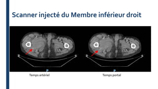 Scanner injecté du Membre inférieur droit
Temps artériel Temps portal
 