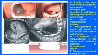Marsupialization Small Ranula Lecture 5 Diagnosis and management of salivary gland disorders Part 2 ...