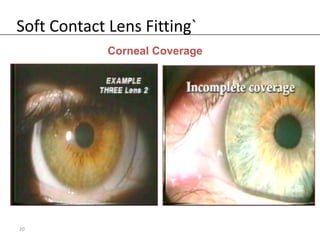 Soft Contact Lens Fitting`
             Corneal Coverage




20
 
