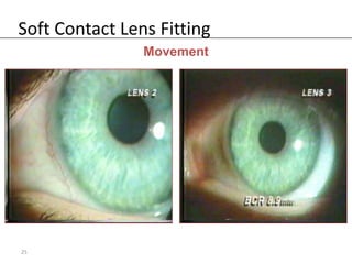 Soft Contact Lens Fitting
                Movement




25
 