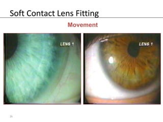 Soft Contact Lens Fitting
                Movement




26
 