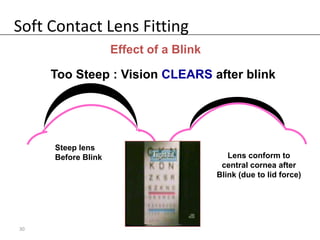 Soft Contact Lens Fitting
                    Effect of a Blink

     Too Steep : Vision CLEARS after blink




     Steep lens
     Before Blink                          Lens conform to
                                         central cornea after
                                        Blink (due to lid force)




30
 