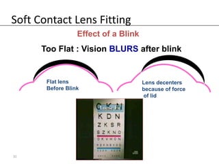 Soft Contact Lens Fitting
                  Effect of a Blink
      Too Flat : Vision BLURS after blink


       Flat lens                      Lens decenters
       Before Blink                   because of force
                                      of lid




31
 