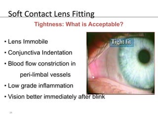 Soft Contact Lens Fitting
            Tightness: What is Acceptable?

• Lens Immobile
• Conjunctiva Indentation
• Blood flow constriction in
       peri-limbal vessels
• Low grade inflammation
• Vision better immediately after blink

  34
 