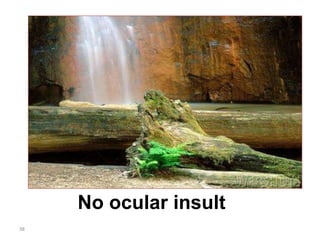 No ocular insult
38
 