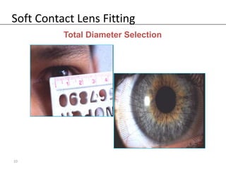 Soft Contact Lens Fitting
          Total Diameter Selection




10
 