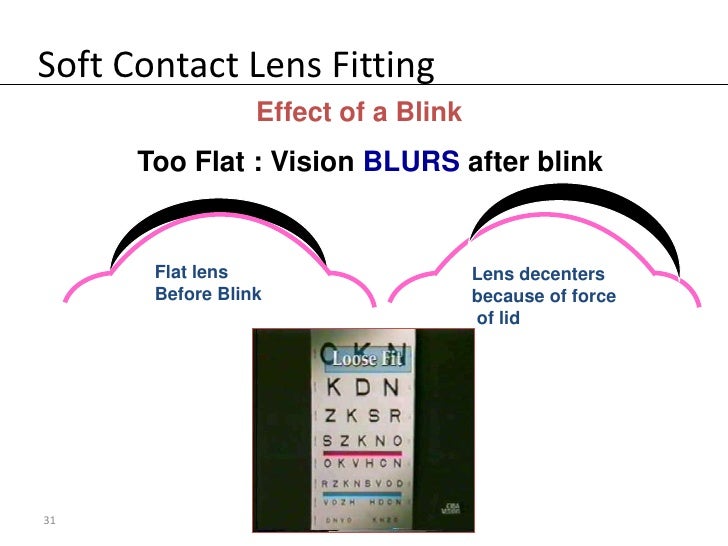 Soft Contact Lens Fitting