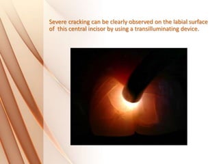 Severe cracking can be clearly observed on the labial surface
of this central incisor by using a transilluminating device.
 