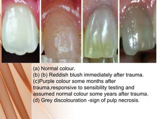 (a) Normal colour.
(b) (b) Reddish blush immediately after trauma.
(c)Purple colour some months after
trauma,responsive to sensibility testing and
assumed normal colour some years after trauma.
(d) Grey discolouration -sign of pulp necrosis.
 