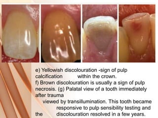 e) Yellowish discolouration -sign of pulp
calcification within the crown.
f) Brown discolouration is usually a sign of pulp
necrosis. (g) Palatal view of a tooth immediately
after trauma
viewed by transillumination. This tooth became
responsive to pulp sensibility testing and
the discolouration resolved in a few years.
 