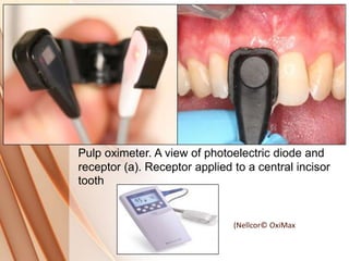 (Nellcor© OxiMax
Pulp oximeter. A view of photoelectric diode and
receptor (a). Receptor applied to a central incisor
tooth
 