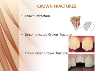 CROWN FRACTURES
• Crown Infraction
• Uncomplicated Crown fracture
• Complicated Crown fracture
 