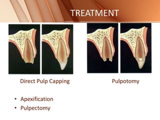 TREATMENT
Direct Pulp Capping Pulpotomy
• Apexification
• Pulpectomy
 