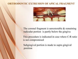 ORTHODONTIC EXTRUSION OF APICAL FRAGMENT
The coronal fragment is unrestorable & remaining
radicular portion is partly below the gingiva
This procedure is indicated in case where C:R ratio
is not compromised
Subgingival portion is made to supra gingival
position
 