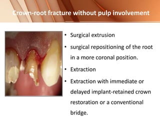 Crown-root fracture without pulp involvement
• Surgical extrusion
• surgical repositioning of the root
in a more coronal position.
• Extraction
• Extraction with immediate or
delayed implant-retained crown
restoration or a conventional
bridge.
 