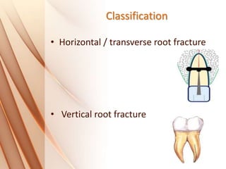 Classification
• Horizontal / transverse root fracture
• Vertical root fracture
 