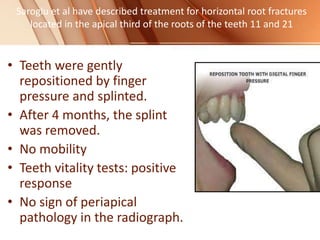 Saroglu et al have described treatment for horizontal root fractures
located in the apical third of the roots of the teeth 11 and 21
• Teeth were gently
repositioned by finger
pressure and splinted.
• After 4 months, the splint
was removed.
• No mobility
• Teeth vitality tests: positive
response
• No sign of periapical
pathology in the radiograph.
 