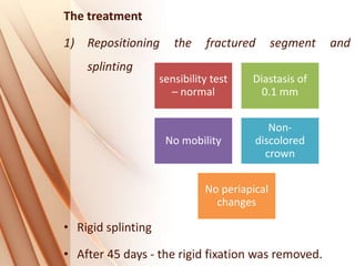 The treatment
1) Repositioning the fractured segment and
splinting
• Rigid splinting
• After 45 days - the rigid fixation was removed.
sensibility test
– normal
Diastasis of
0.1 mm
No mobility
Non-
discolored
crown
No periapical
changes
 