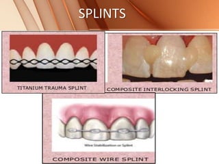 SPLINTS
 