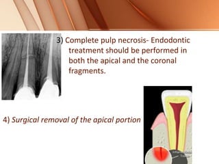 3) Complete pulp necrosis- Endodontic
treatment should be performed in
both the apical and the coronal
fragments.
4) Surgical removal of the apical portion
 