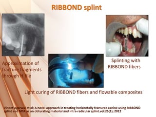 RIBBOND splint
Vineet Agarwal et al; A novel approach in treating horizontally fractured canine using RIBBOND
splint and MTA as an obturating material and intra-radicular splint.vol:25(1); 2012
Approximation of
fracture fragments
through H file
Splinting with
RIBBOND fibers
Light curing of RIBBOND fibers and flowable composites
 