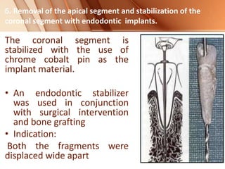 The coronal segment is
stabilized with the use of
chrome cobalt pin as the
implant material.
• An endodontic stabilizer
was used in conjunction
with surgical intervention
and bone grafting
• Indication:
Both the fragments were
displaced wide apart
6. Removal of the apical segment and stabilization of the
coronal segment with endodontic implants.
 