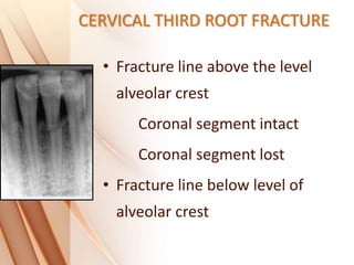 CERVICAL THIRD ROOT FRACTURE
• Fracture line above the level
alveolar crest
Coronal segment intact
Coronal segment lost
• Fracture line below level of
alveolar crest
 