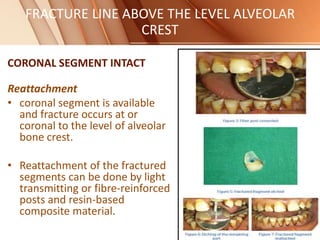 FRACTURE LINE ABOVE THE LEVEL ALVEOLAR
CREST
CORONAL SEGMENT INTACT
Reattachment
• coronal segment is available
and fracture occurs at or
coronal to the level of alveolar
bone crest.
• Reattachment of the fractured
segments can be done by light
transmitting or fibre-reinforced
posts and resin-based
composite material.
 