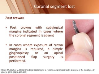 Coronal segment lost
Post crowns
• Post crowns with subgingival
margins indicated in cases where
the coronal segment is absent
• In cases where exposure of crown
margins is required, a simple
gingivoplasty or an apical
positioned flap surgery is
performed.
Owen TA, Barber M. Direct or indirect post crowns to restore compromised teeth: a review of the literature. Br
Dent J. 2018;224(6):413‐418.
 