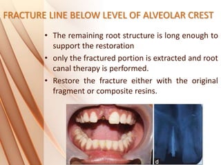 FRACTURE LINE BELOW LEVEL OF ALVEOLAR CREST
• The remaining root structure is long enough to
support the restoration
• only the fractured portion is extracted and root
canal therapy is performed.
• Restore the fracture either with the original
fragment or composite resins.
 