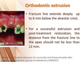 Orthodontic extrusion
• Fracture line extends deeply up
to 6 mm below the alveolar crest.
• For a successful extrusion and
post-treatment restoration, the
distance from the fracture line to
the apex should not be less than
12 mm.
Mehmet et al Surgical extrusion of a cervically root-fractured tooth after
apexification treatment. journal of endodontics;199925(7)
 
