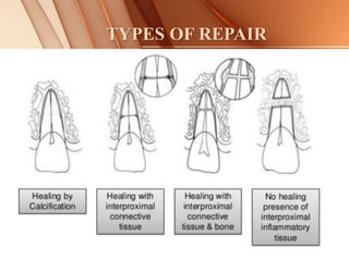 TYPES OF REPAIR
 