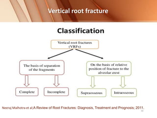 Vertical root fracture
Neeraj Malhotra et al;A Review of Root Fractures: Diagnosis, Treatment and Prognosis; 2011.
 