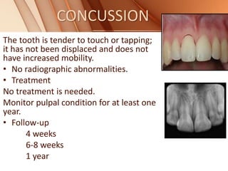 CONCUSSION
The tooth is tender to touch or tapping;
it has not been displaced and does not
have increased mobility.
• No radiographic abnormalities.
• Treatment
No treatment is needed.
Monitor pulpal condition for at least one
year.
• Follow-up
4 weeks
6-8 weeks
1 year
 