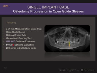 # 23
                           SINGLE IMPLANT CASE
             Osteotomy Progression in Open Guide Sleeves


       Featuring

     3 x1 mm Magnetic Offset Guide Post
     Open Guide Sleeve
     Utilizing Cosine Rule
     Generation ll Bending Tool
     GALAXIS Software Evaluaton
     Invivo5 Software Evaluation
     Drill series in SURGICAL Guide




    TUIT
 
