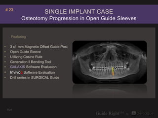 # 23
                           SINGLE IMPLANT CASE
             Osteotomy Progression in Open Guide Sleeves


       Feat...