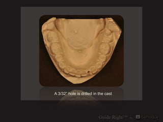 A 3/32” hole is drilled in the cast
 