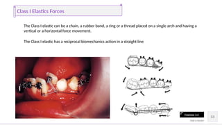 Comprehensive Orthodontic Space Closure Techniques and Biomechanics | PPTX