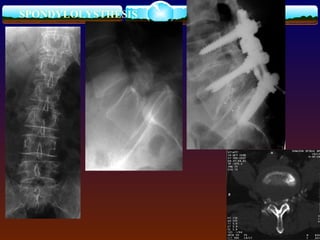 SPONDYLOLYSTHESIS
 