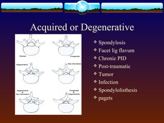 Acquired or Degenerative
 Spondylosis
 Facet lig flavum
 Chronic PID
 Post-traumatic
 Tumor
 Infection
 Spondylolisthesis
 pagets
 