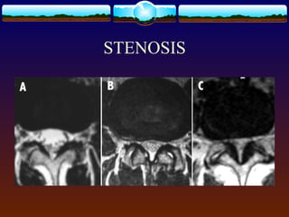 STENOSIS
 