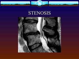 STENOSIS
 